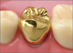 歯科材料について-金属系- | 歯の診療・治療、インプラント、矯正の ...